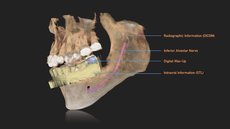Dental Designs Clinic - how dental implants offer more than just the replacement of missing teeth