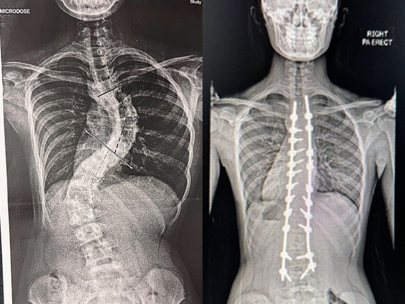 Scoliosis treatment in Singapore like scoliosis braces - DR LAU LEOK LIM, Senior Consultant Orthopaedic Surgeon at Orthopaedic and Hand Surgery Partners