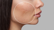 How to get rid of acne scars with radiofrequency microneedling or fractional CO2 laser - Parkway MediCentre Dermatology Clinic - acne scars scar treatments in Singapore