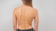 How to tell if you have scoliosis - orthopaedic surgeon Dr Lau Leok Lim shares his views on symptoms of scoliosis plus workouts that can help.