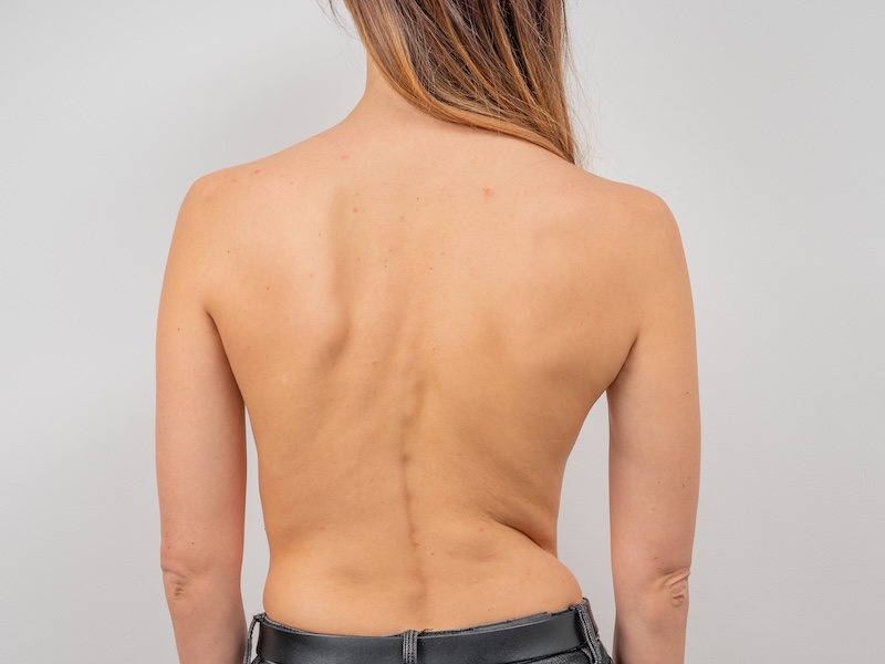 How to tell if you have scoliosis - orthopaedic surgeon Dr Lau Leok Lim shares his views on symptoms of scoliosis plus workouts that can help.
