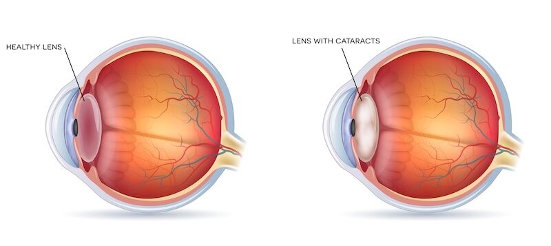 cataracts