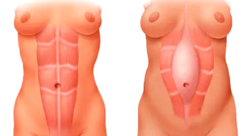 Body contouring, plastic surgery in Singapore - Dr Pearlie Tan from Pearl Plastic Surgery, Laser & Scar Clinic - rib remodelling, diastasis recti repair, liposuction, tummy tucks, fat grafting diastasis recti repair