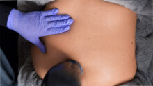 Non-invasive body contouring treatment in Singapore with SSKINS Dr Angeline Yong - Alma PrimeX, skin tightening, skin laxity, fat reduction, body sculpting